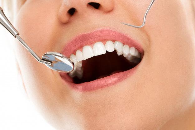Prótese Protocolo: Sobre Implantes Dentários